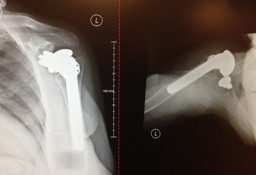 This humeral  implant is anterior to the glenoid